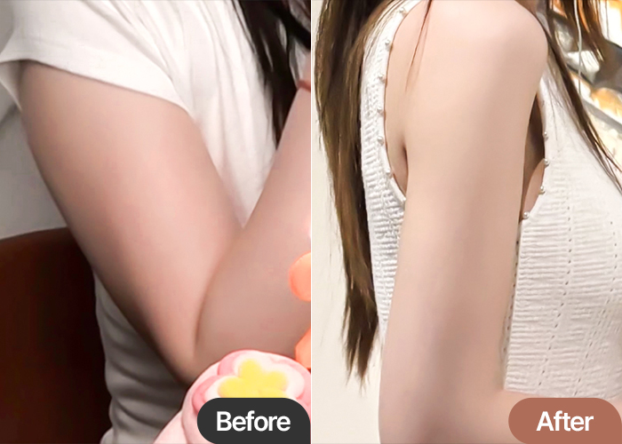 Arm liposuction | I would have regretted it if I went to another clinic!