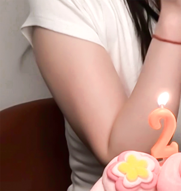 arm-liposuction-usahachi-before