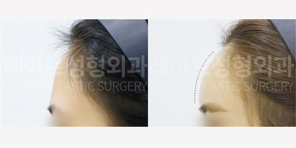 lesarts facial fat grafting before and after