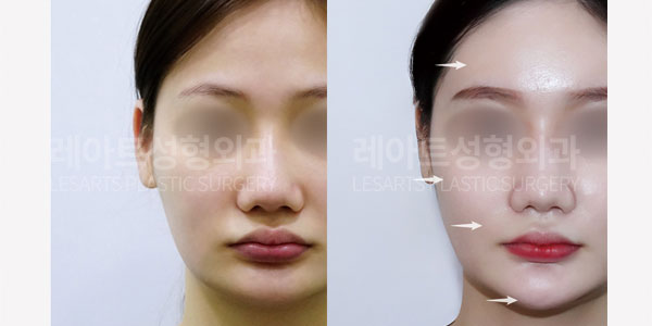 lesarts facial fat grafting before and after