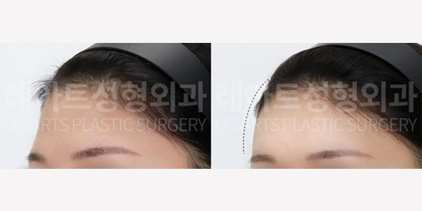 lesarts facial fat grafting before and after