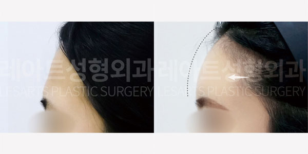 lesarts facial fat grafting before and after