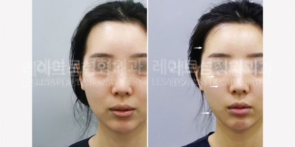 lesarts facial fat grafting before and after