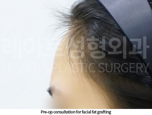 facial-fat-transfer-02-01-251210
