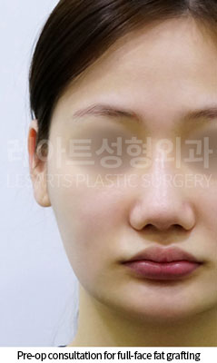 facial-fat-transfer-02-01-251217