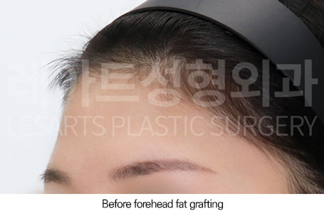 facial-fat-transfer-02-01-251223