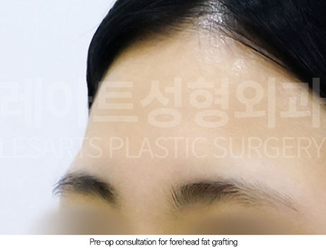 facial-fat-transfer-02-01-251230