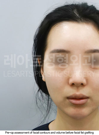 facial-fat-transfer-02-01-260610