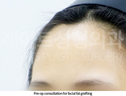 facial-fat-transfer-02-02-251210