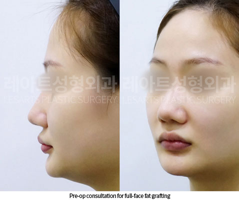 facial-fat-transfer-02-02-251217