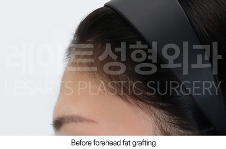 facial-fat-transfer-02-02-251223