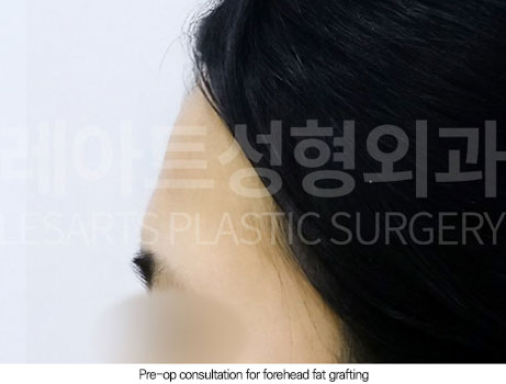 facial-fat-transfer-02-02-251230