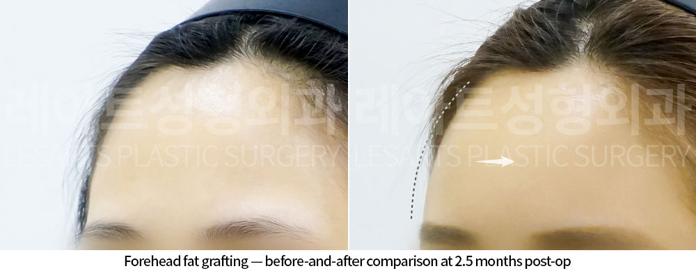 facial-fat-transfer-02-03-251210
