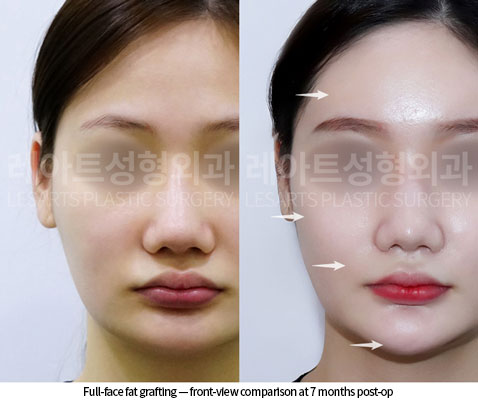 facial-fat-transfer-02-03-251217
