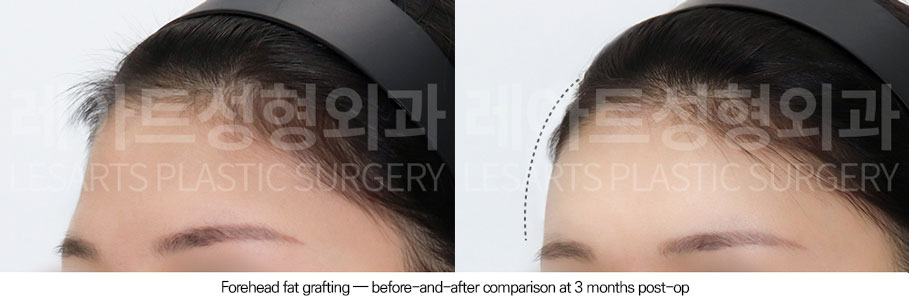 facial-fat-transfer-02-03-251223