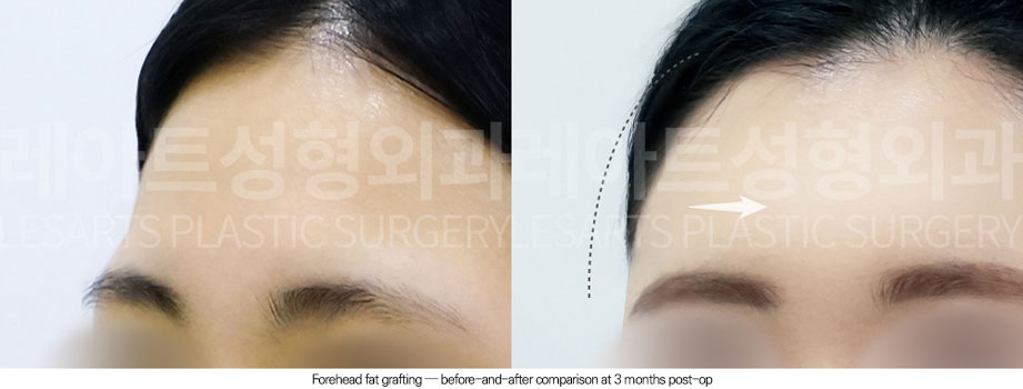 facial-fat-transfer-02-03-251230