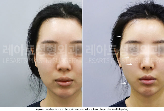 facial-fat-transfer-02-03-260610