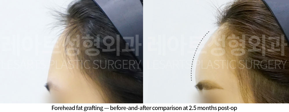 facial-fat-transfer-02-04-251210