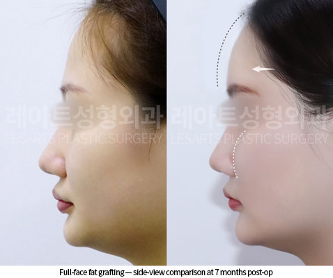 facial-fat-transfer-02-04-251217