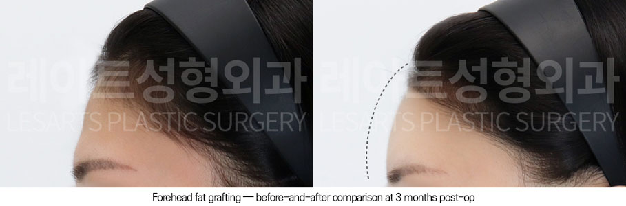 facial-fat-transfer-02-04-251223