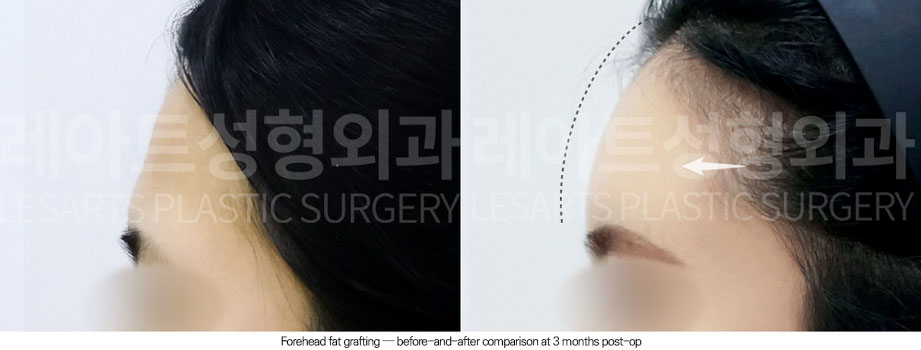 facial-fat-transfer-02-04-251230