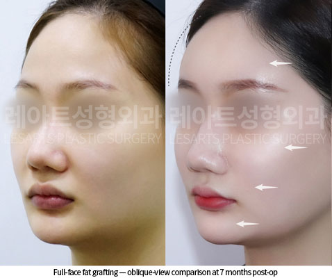 facial-fat-transfer-02-05-251217