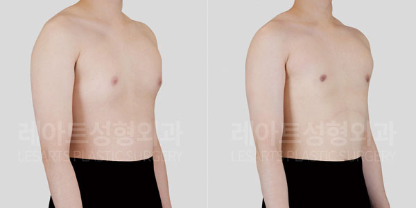 gynecomastia-01-thumbnail-260528