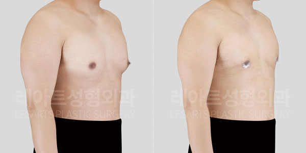 lesarts gynecomastia before and after