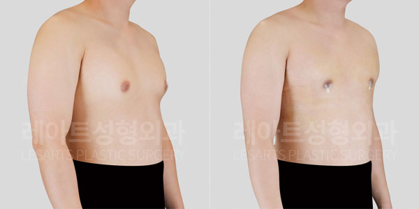 lesarts gynecomastia before and after