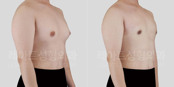 gynecomastia-01-thumbnail-260608