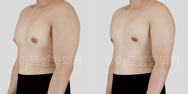 lesarts gynecomastia before and after