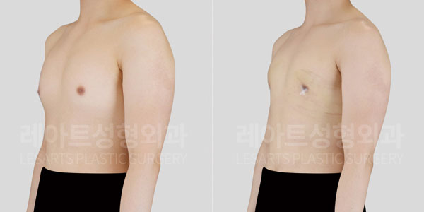 lesarts gynecomastia before and after