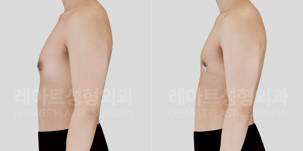 lesarts gynecomastia before and after