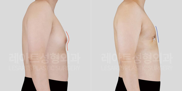 lesarts gynecomastia before and after