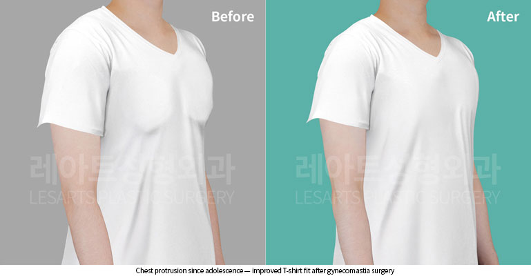 gynecomastia-02-01-260528