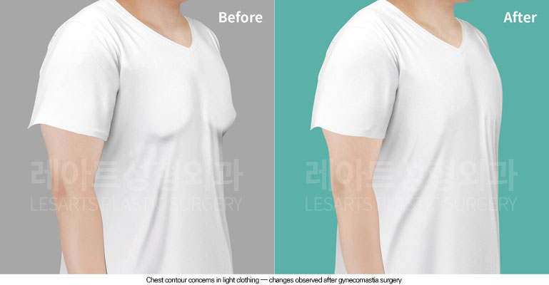 gynecomastia-02-01-260601