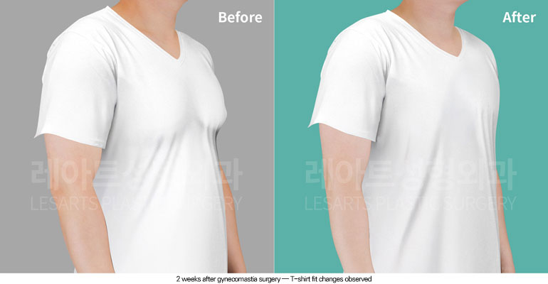 gynecomastia-02-01-260604