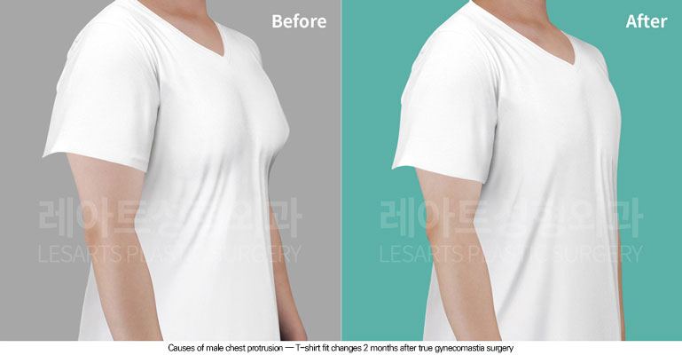 gynecomastia-02-01-260608