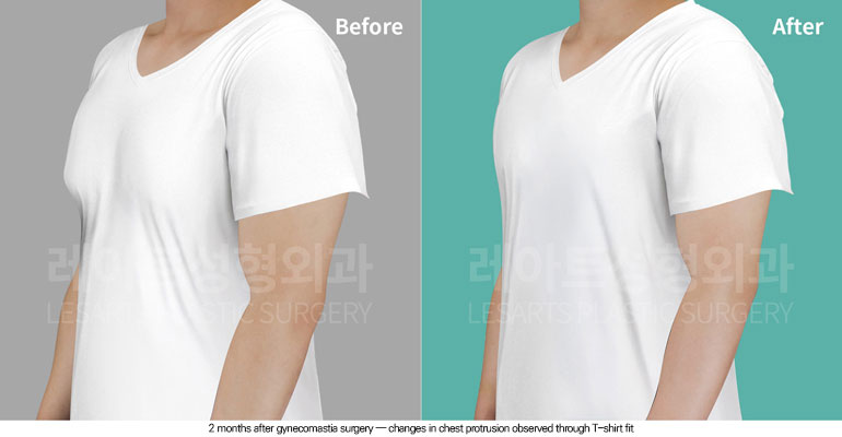 gynecomastia-02-01-260611