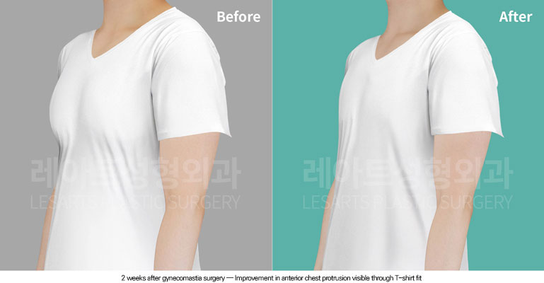 gynecomastia-02-01-260615