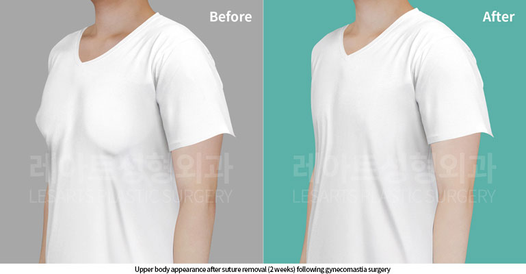 gynecomastia-02-01-260617