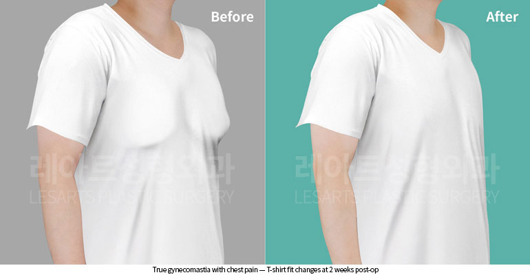 gynecomastia-02-01-260622