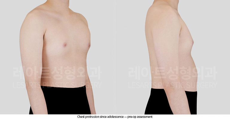 gynecomastia-02-02-260528