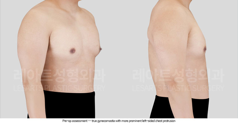 gynecomastia-02-02-260601
