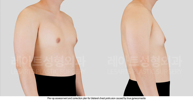 gynecomastia-02-02-260604