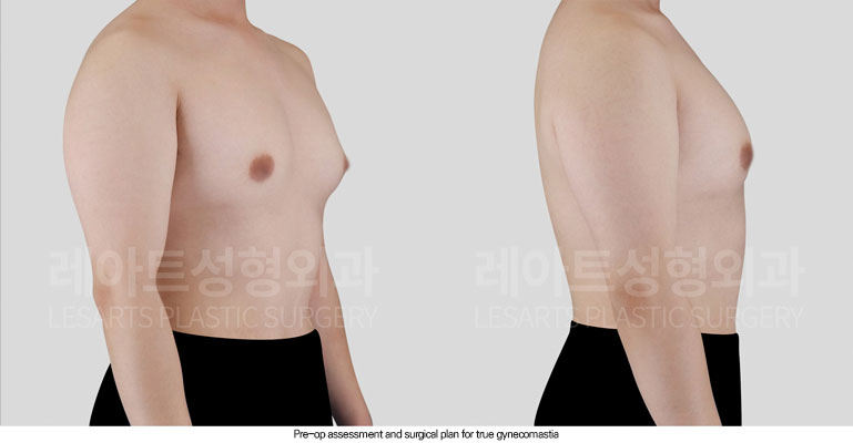 gynecomastia-02-02-260608