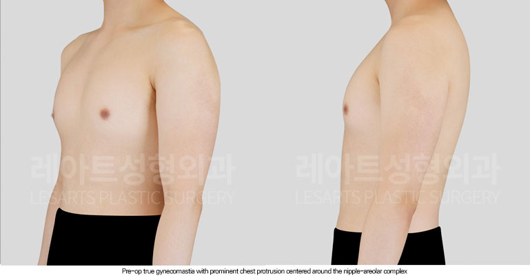 gynecomastia-02-02-260615