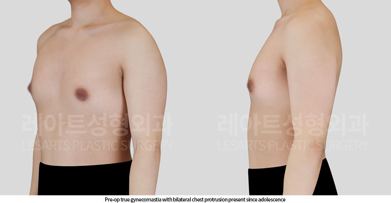 gynecomastia-02-02-260617