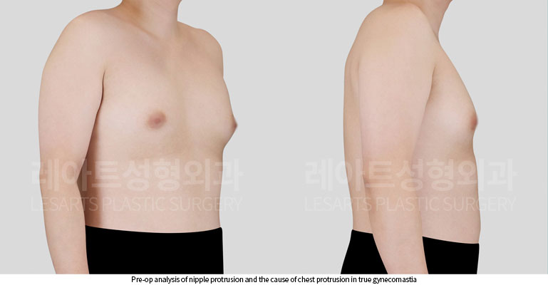 gynecomastia-02-02-260622