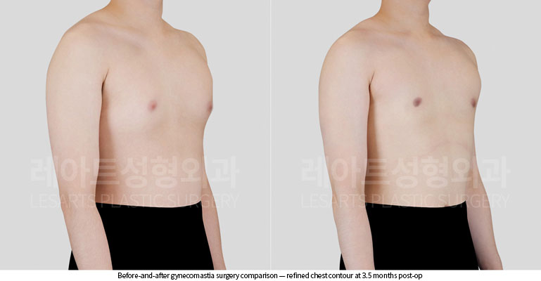 gynecomastia-02-03-260528